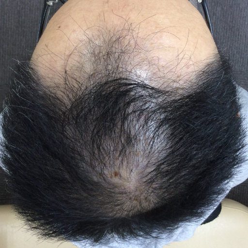 40代の男性、６ヶ月で髪が増えた写真