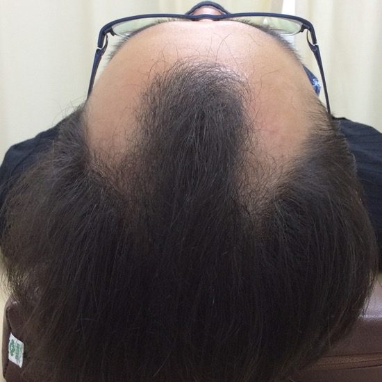 ２０代男性　発毛０ヶ月