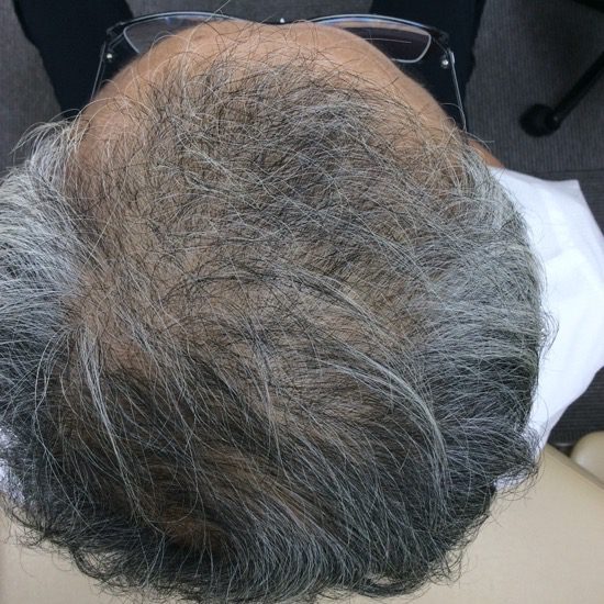 60代男性　発毛１２ヶ月