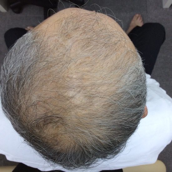 60代男性　発毛３ヶ月