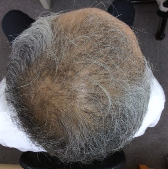 60代男性　発毛６ヶ月