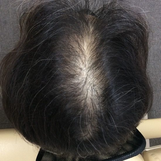 ７０代女性　発毛１２ヶ月　頭上